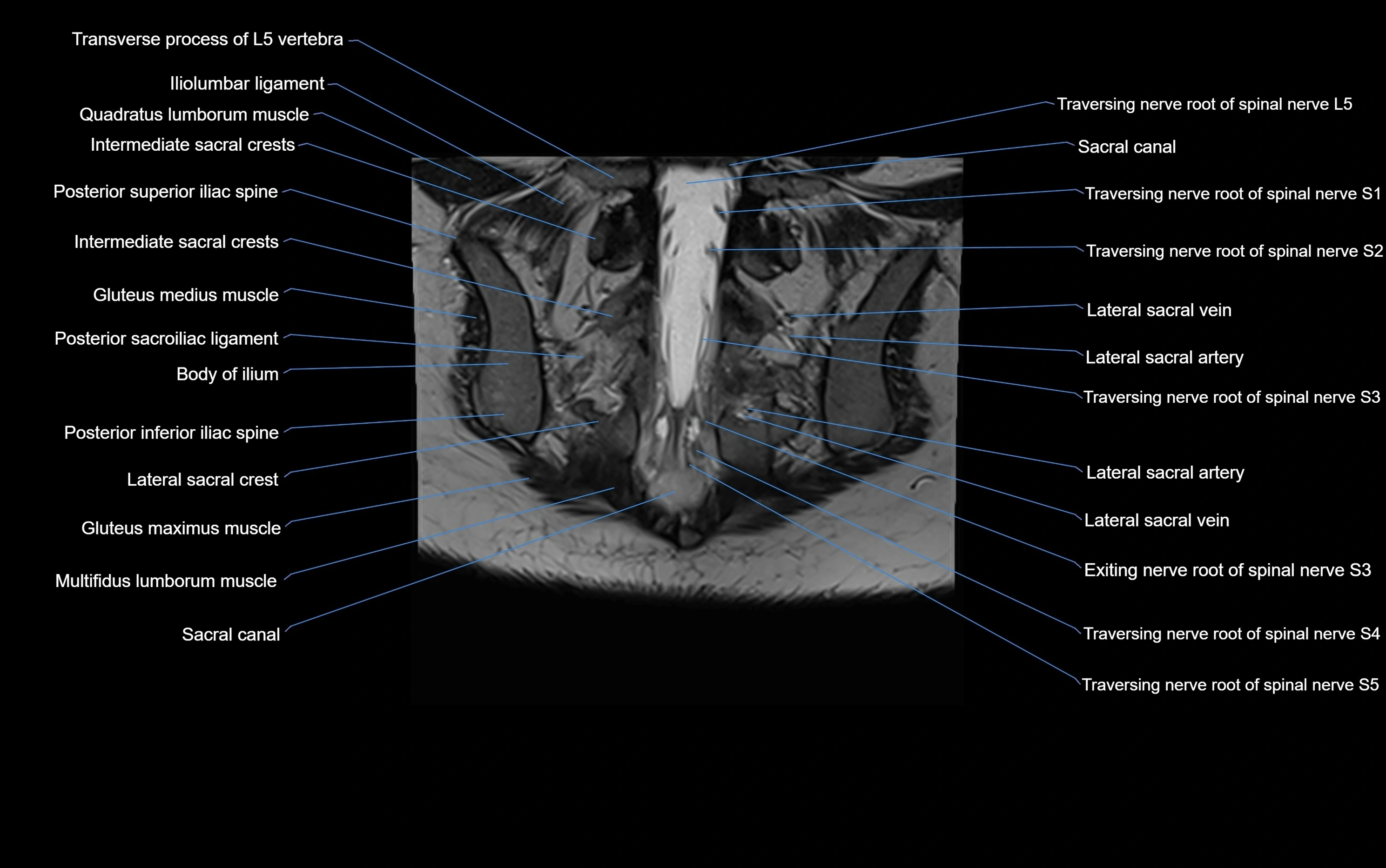 MRI sacroiliac joint coronal cross sectional anatomy  radiology  image-img-00001-00025.webp